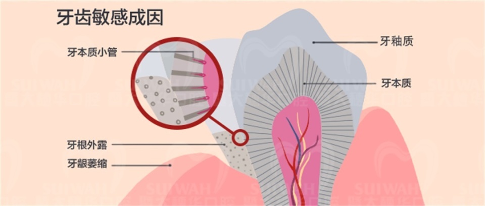 牙疼冷热敏感还痛怎么办,牙齿敏感一吃甜的就牙疼该怎么办