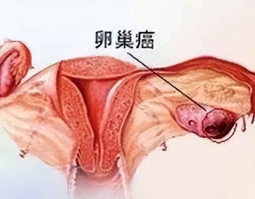 卵巢癌切片基因检测与靶向治疗,卵巢癌靶向治疗一年多少钱