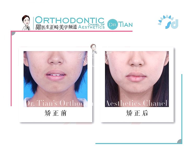 不拔牙矫正嘴凸下巴后缩案例,嘴瘪不拔牙矫正嘴会凸怎么办