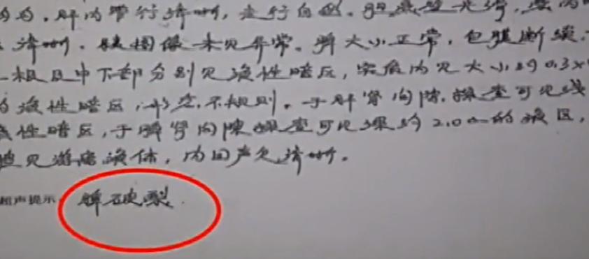 女孩单位体检时少一个肾最后结果,入职体检查出少个肾