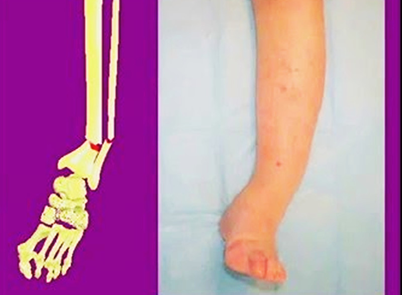 骨折三个月没有骨痂怎么办,骨折五个月没愈合是骨不连吗