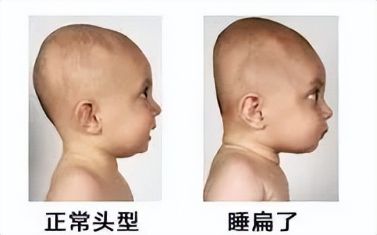 扁头有多毁颜值,扁头对颜值影响有多大