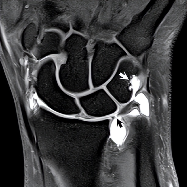 三角纤维软骨复合体磁共振,三角软骨复合体损伤核磁共振图