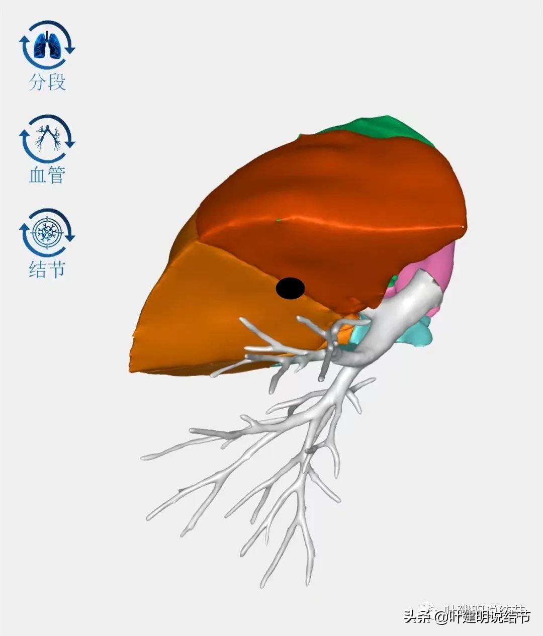 2cm的肺磨玻璃结节如何处理最合适,年轻女人磨玻璃结节