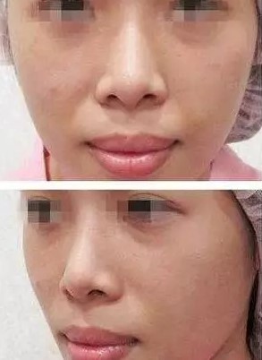 法令纹泛红暗沉做什么医美,法令纹早睡早起消除得了吗