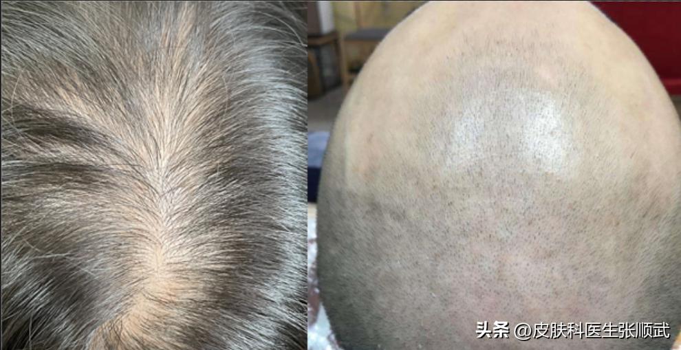 小孩多剃光头可使头发变多吗,大人剃光头能让头发变好吗