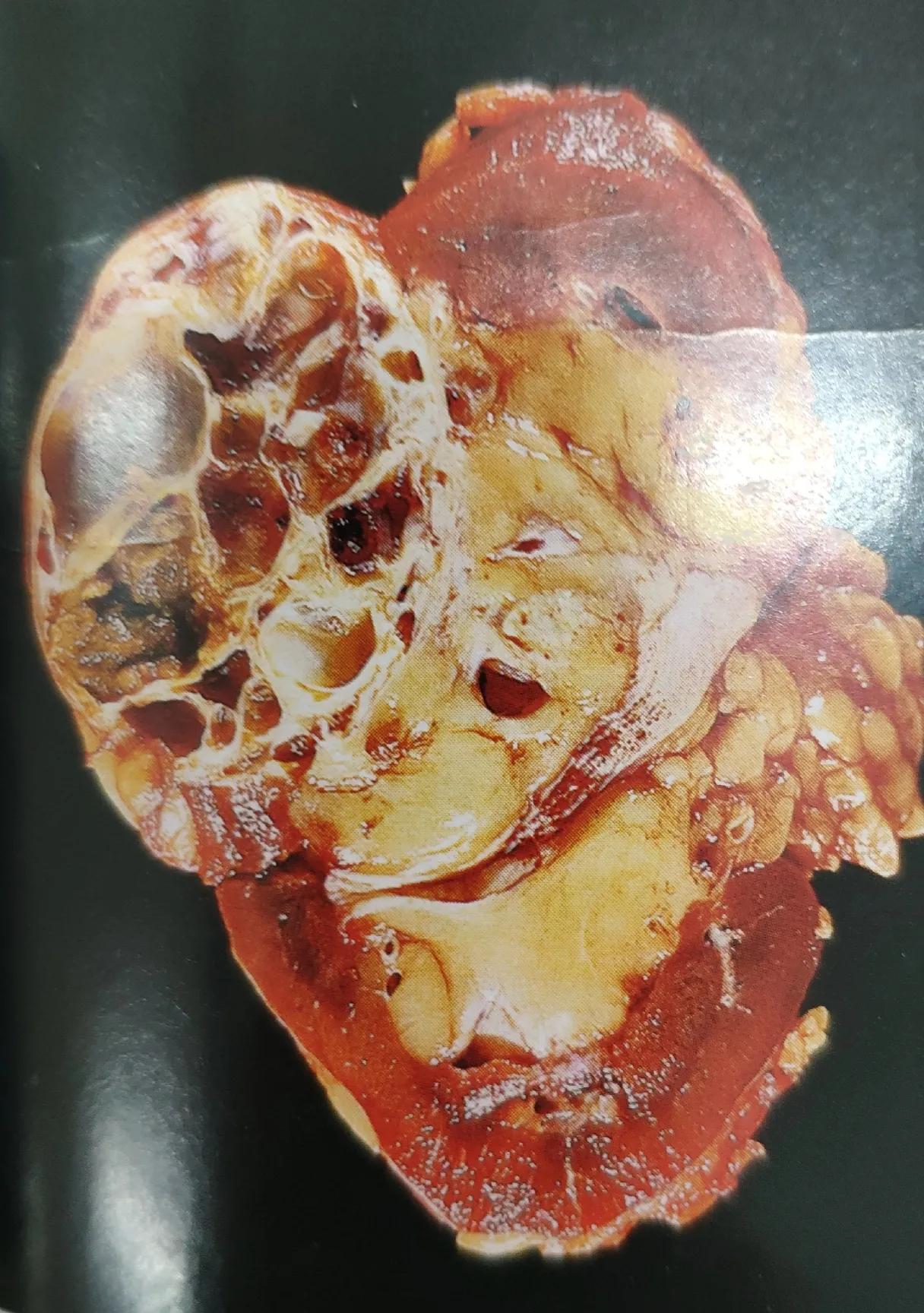 体检发现肾上有肿瘤怎么办,体检肾有个肿块是怎么回事