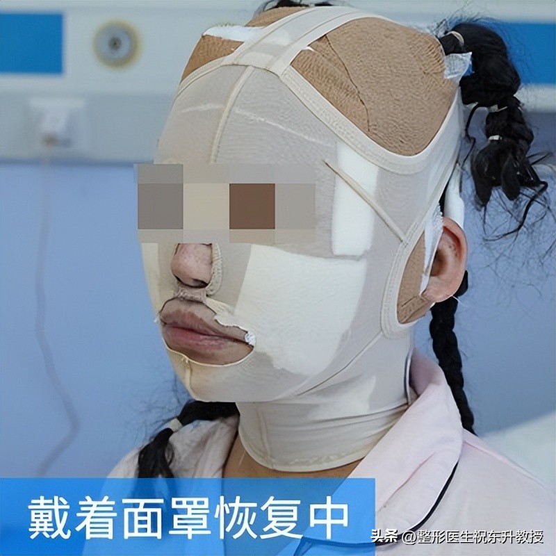 全脸拉皮手术前后的真实对比,脸部拉皮手术恢复过程图