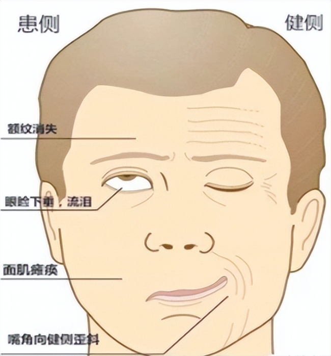 面瘫嘴眼歪斜针灸什么穴位好得快,面瘫嘴向右边歪针灸哪边脸