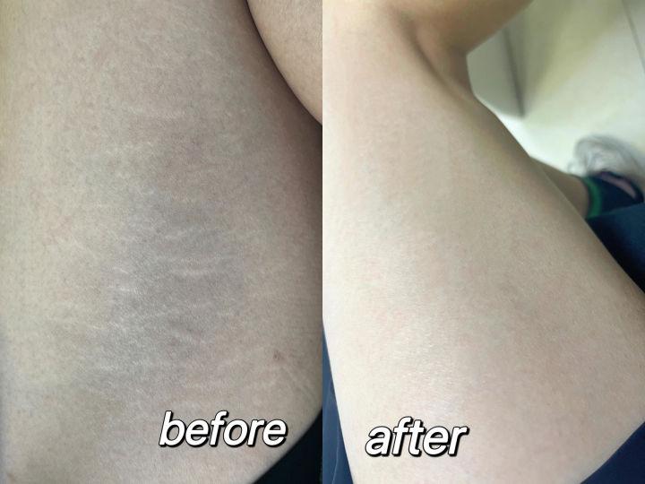 肥胖纹瘦了之后的痕迹怎么消除,淡化肥胖纹的最好方法