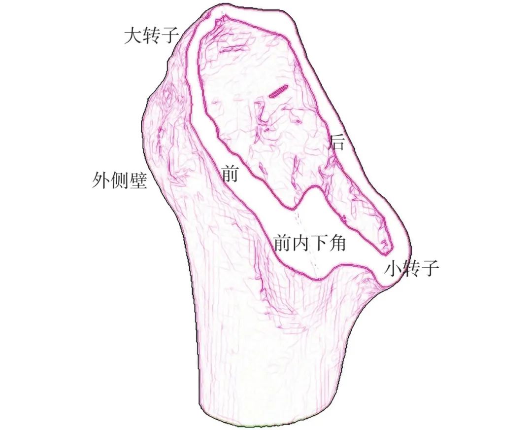 股骨转子间骨折四种手术方法比较,股骨转子间骨折属于轻伤还是重伤