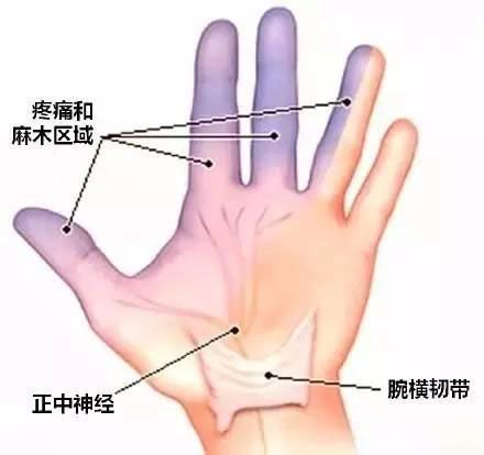 鼠标手腕管综合征挂什么科,白领鼠标手腕管综合征