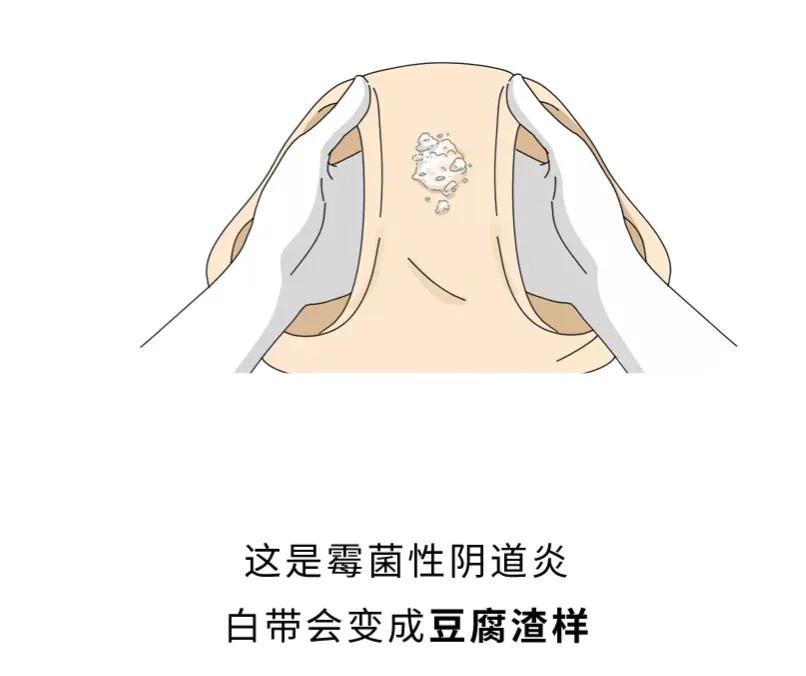 女生*处私**痒，居然是对“小蝌蚪”过敏？