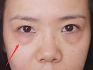 卧蚕眼袋大最简单的去眼袋的方法,消除眼袋方法多勿把卧蚕当眼袋