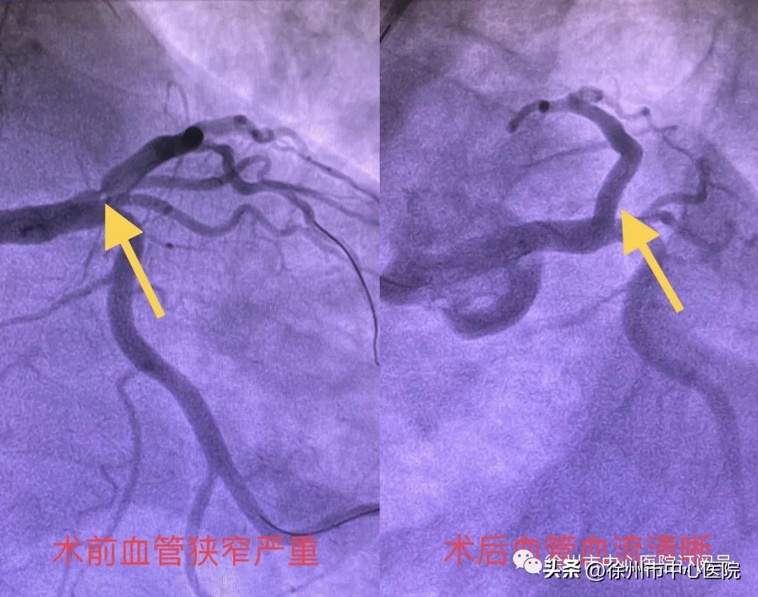 冠状动脉血管内超声属于几级手术,冠状动脉血管介入治疗
