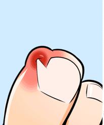 甲沟炎剪指甲太疼了,甲沟炎指甲剪了但是超级疼怎么办