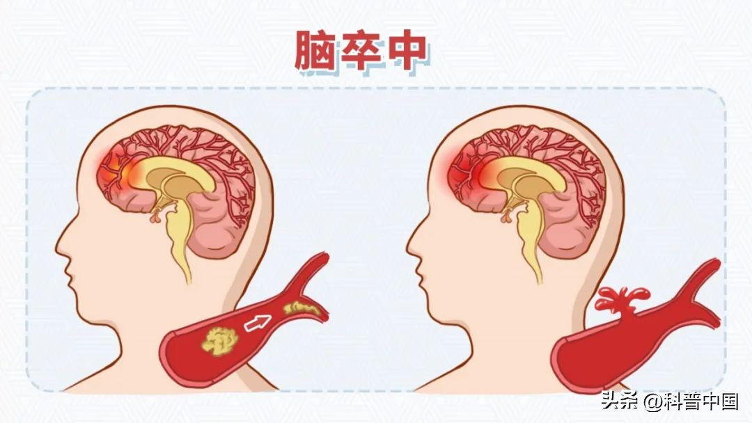 让你少走弯路的健康常识赶紧收藏,威胁人类健康的头号杀手是什么病