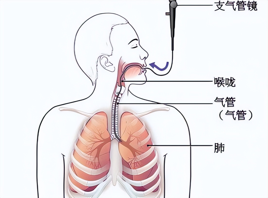胸腔镜下胸膜冷冻活检，在胸腔积液诊断中，有价值和安全性么