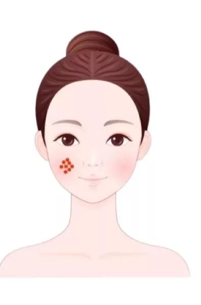 治疗痘痘和痘印最有效的产品内调,腮边反复长大硬包痘痘怎么内调