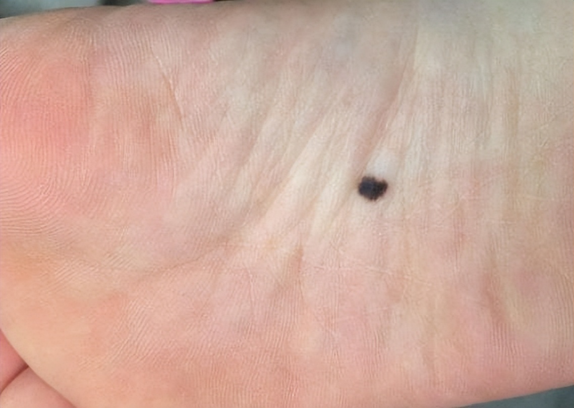 身上的痣分几种,黑痣长毛是活痣还是死痣