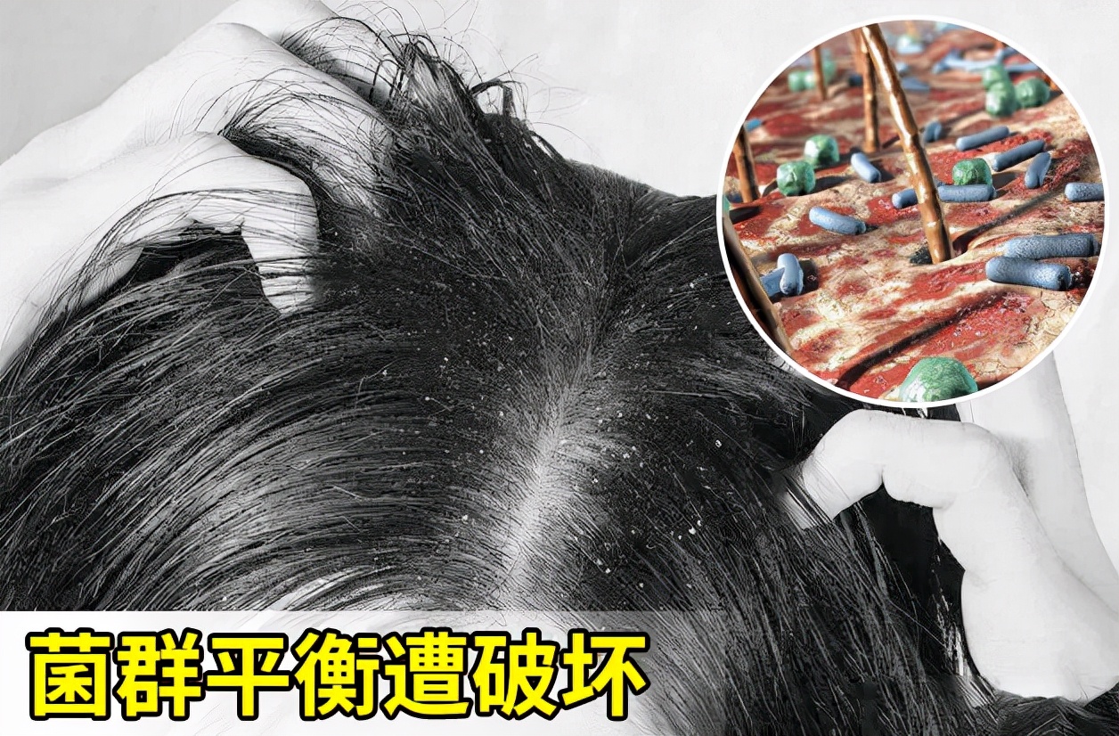 如何改善头皮屑用什么洗发水,如何改善头皮屑