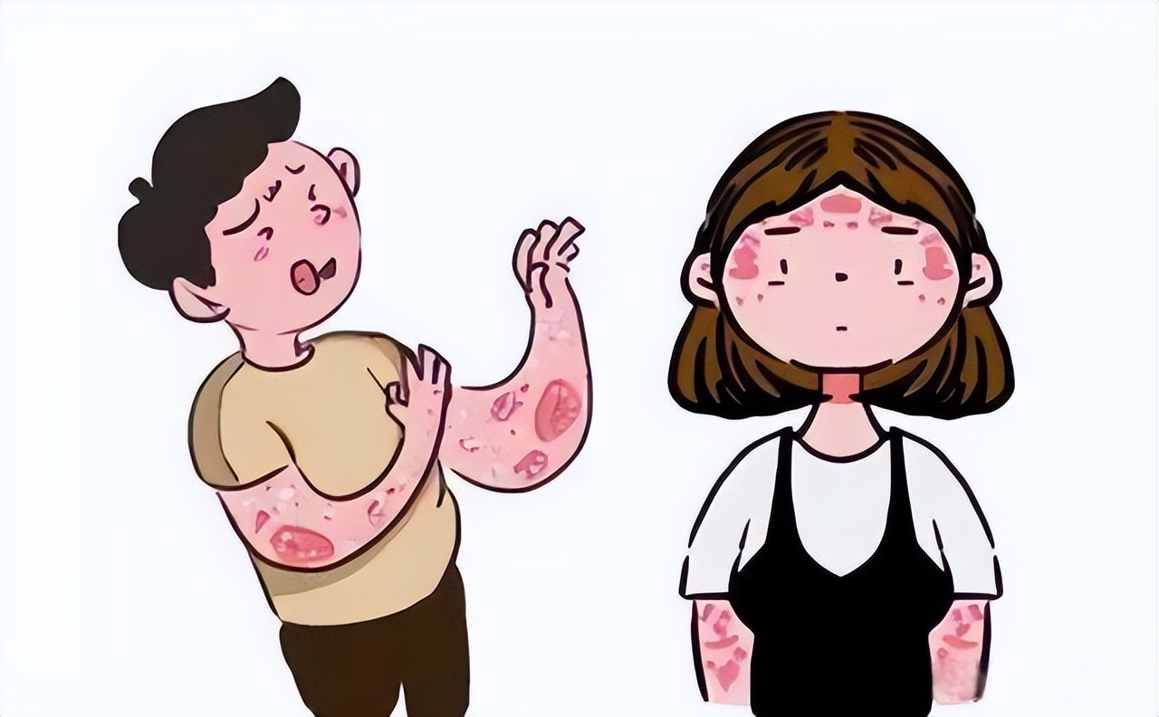 银屑病易与哪些皮肤病混淆,银屑病在人群中的比例