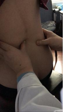 腰椎侧弯腰痛吃什么药,臀肌筋膜炎导致腰椎侧弯