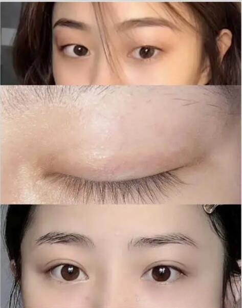 上海做双眼皮哪个医院好,上海哪个医院做双眼皮最好