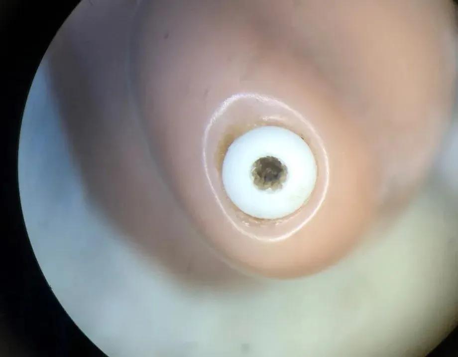 麦克风有异物堵住孔了怎么处理,手机麦克风孔被异物堵了怎么办