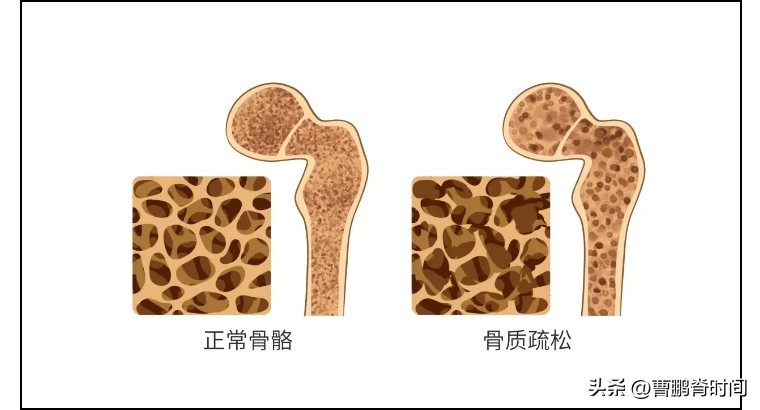 跳绳导致胸椎压缩性骨折,跳绳跳到肋骨脱臼