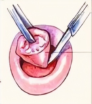宫颈锥切冷刀手术需要缝针吗,宫颈锥切leep和冷刀的区别