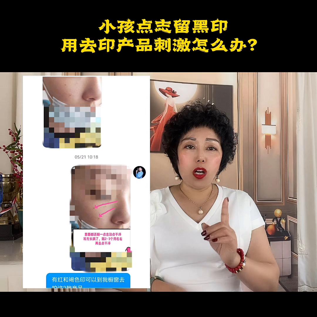 孩子点黑痣用药膏疼吗,孩子点黑点后印记能退掉吗