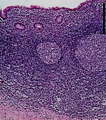 怀孕早期发现有阑尾炎怎么办,怀孕得阑尾炎怎么办胎儿能要吗