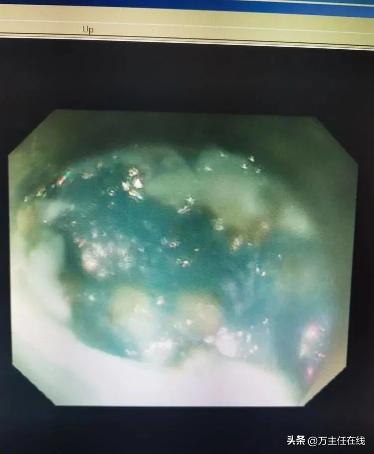 上海第一人民医院消化科万荣教授,消化内科专家手术