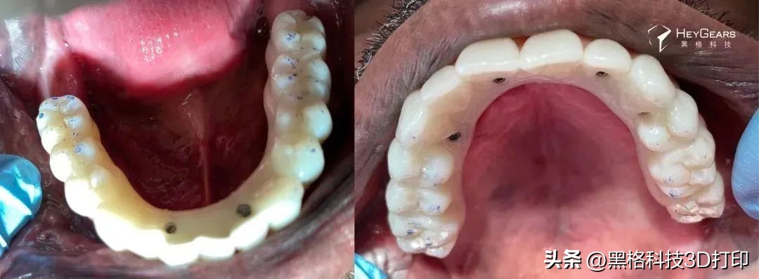 病例分享|美国BDG诊所实现全口即刻修复病例一则