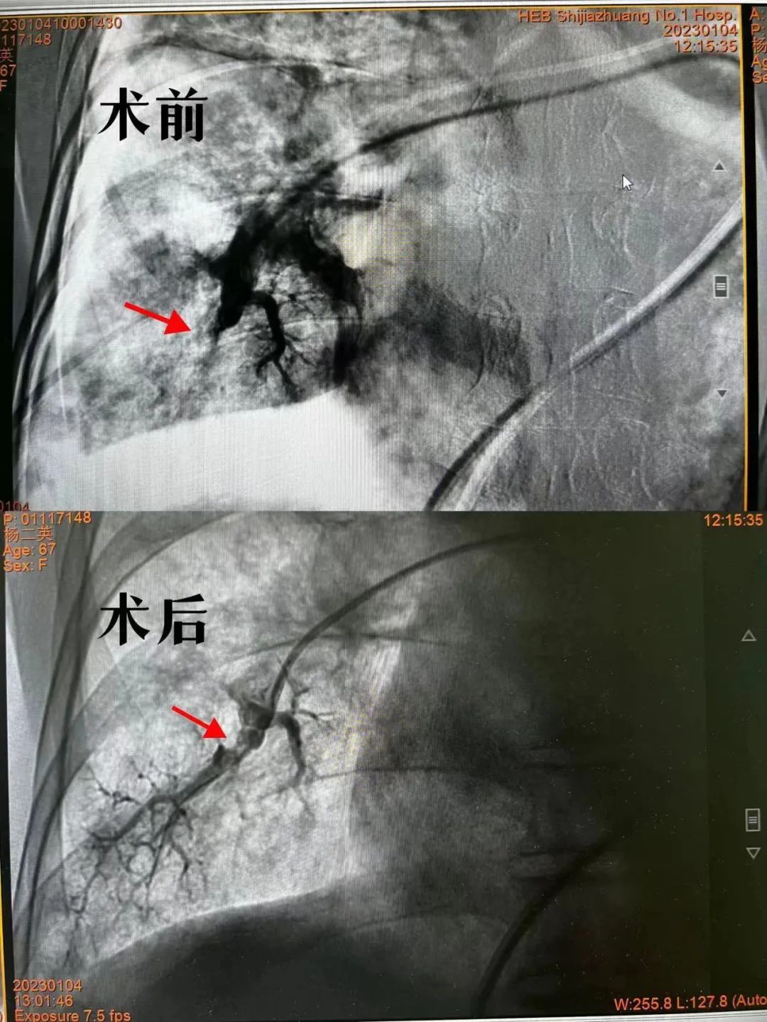 肺血管堵塞引起肺动脉高压严重吗,肺血管球囊扩张肺动脉高压