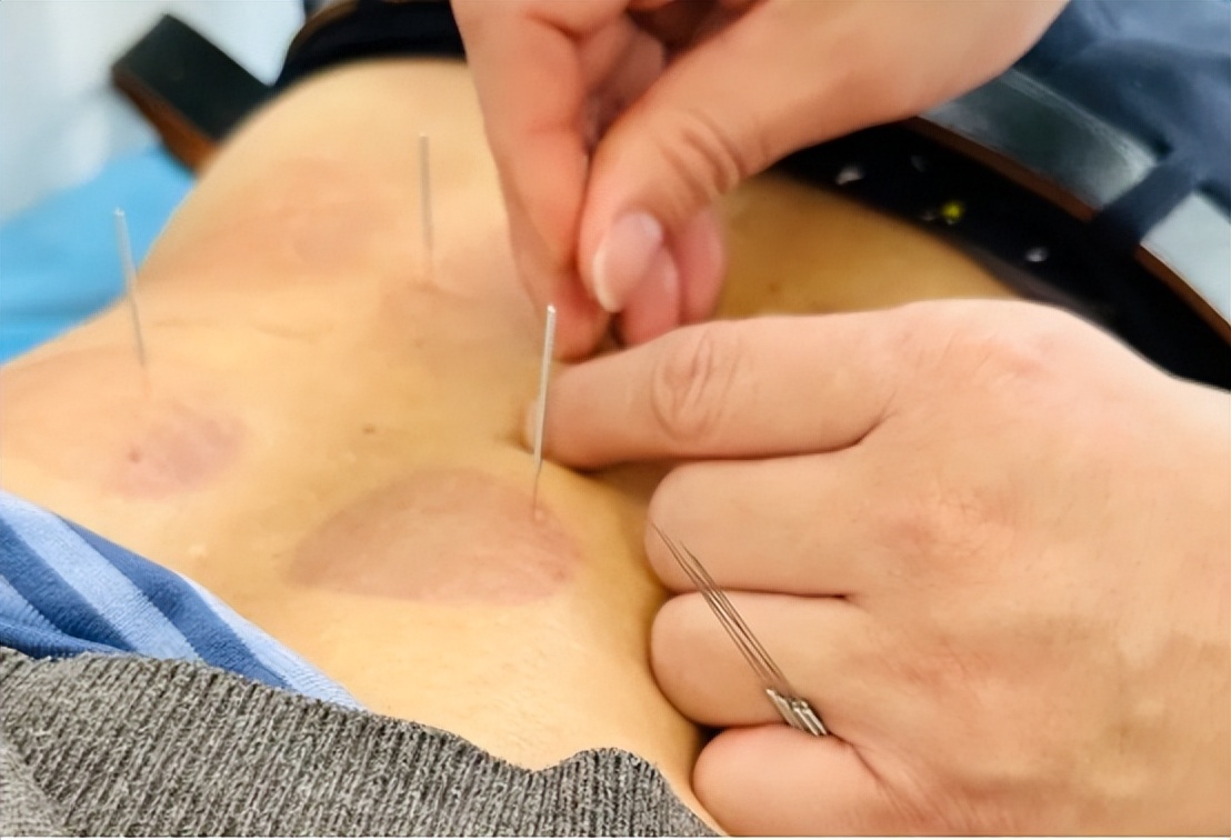 手术引起的尿失禁怎么恢复正常,前列腺手术后复发尿多吃什么药好