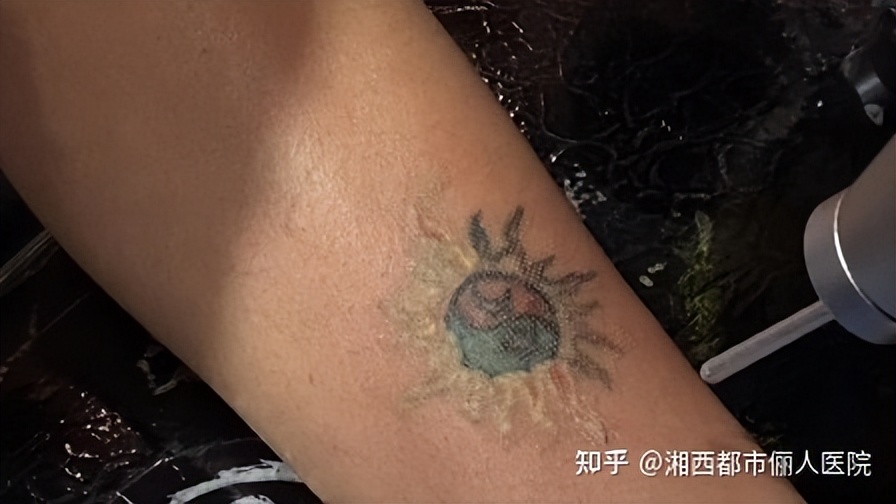 吉首市洗纹身哪家好,张家界洗纹身的价格