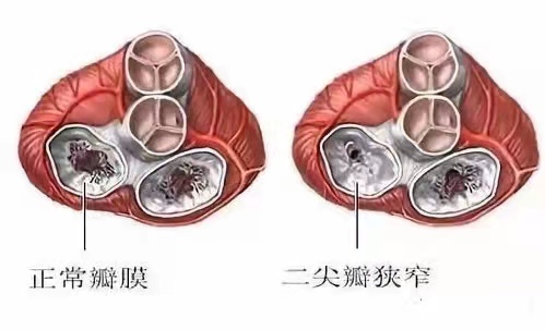 二尖瓣狭窄特征性表现,二尖瓣狭窄可以终身保守治疗吗