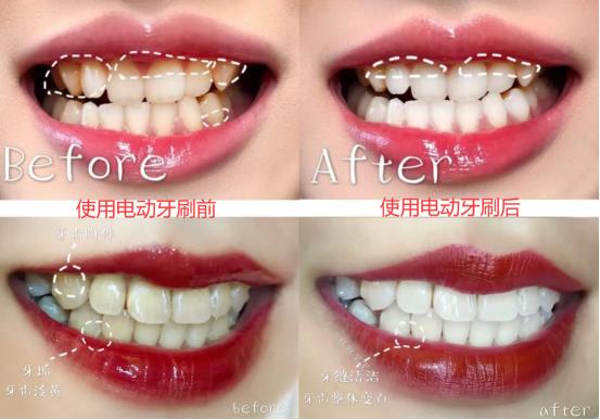 电动牙刷可以预防哪些口腔疾病,电动牙刷对口腔有好处吗