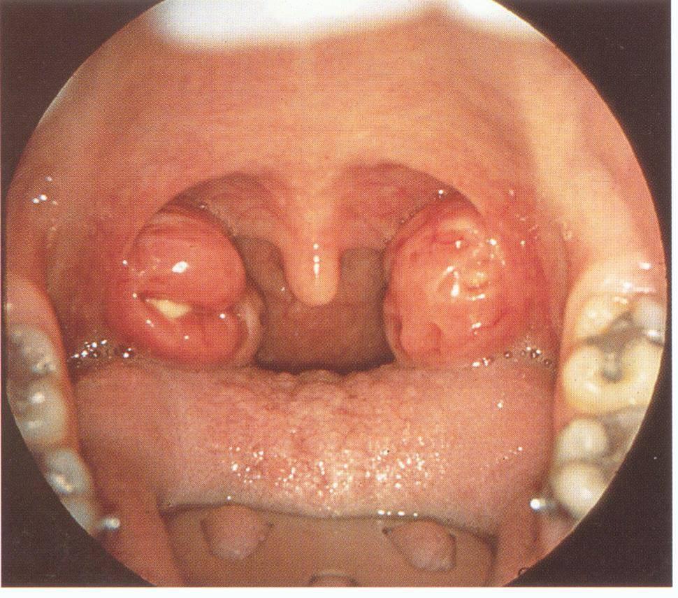 咽部脓肿,咽后壁脓肿的治疗原则