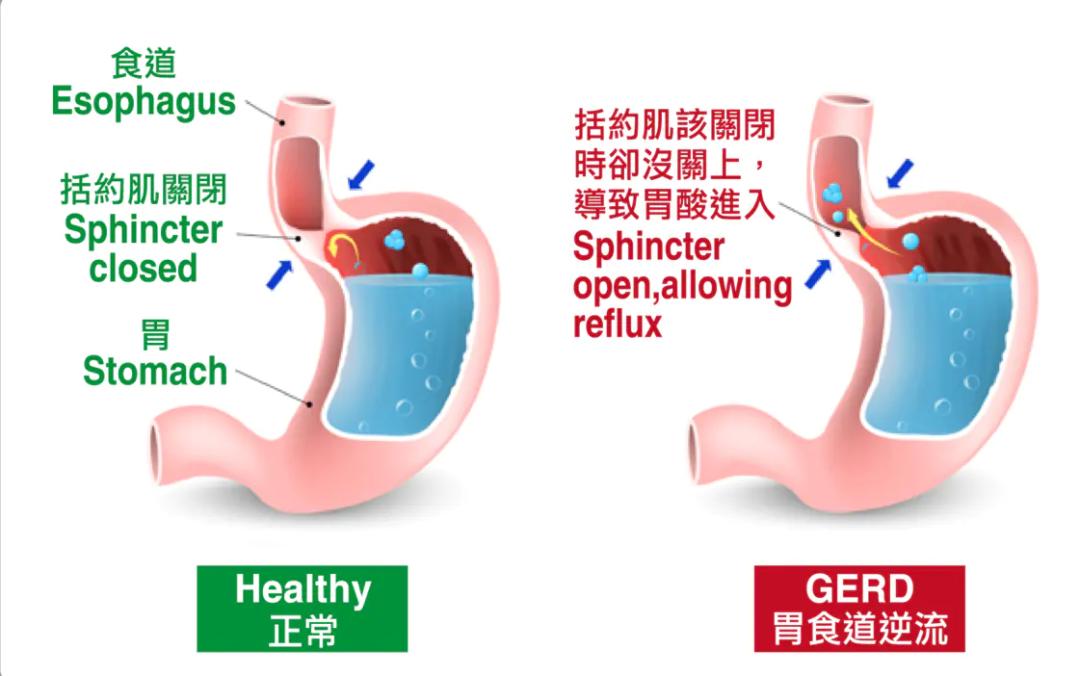 胃胀打嗝口臭,胃胀打嗝打不出嗝口臭