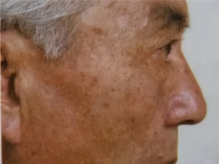 老年斑和色素沉着怎么治,老年人色素沉着怎么去除