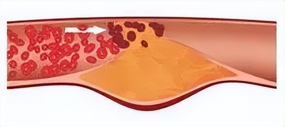 这根血管连通大脑最容易堵!很多人半身不遂后才发现!不看后悔!