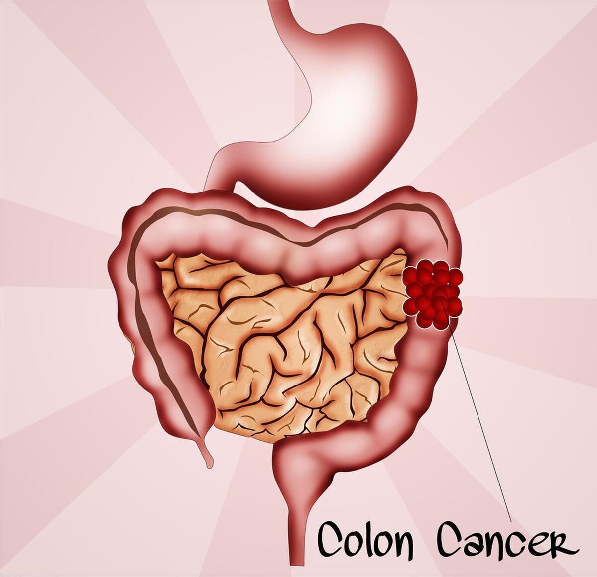 结直肠癌一般发病年龄,结直肠癌的诱因及病因