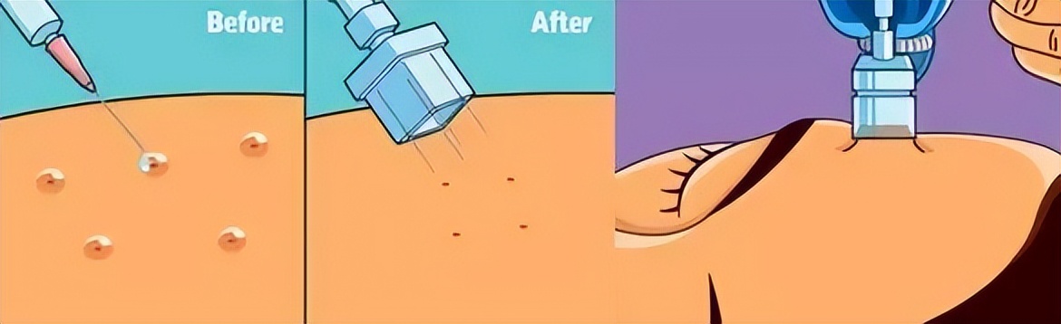 我终于鼓起勇气,打水光针有多痛苦