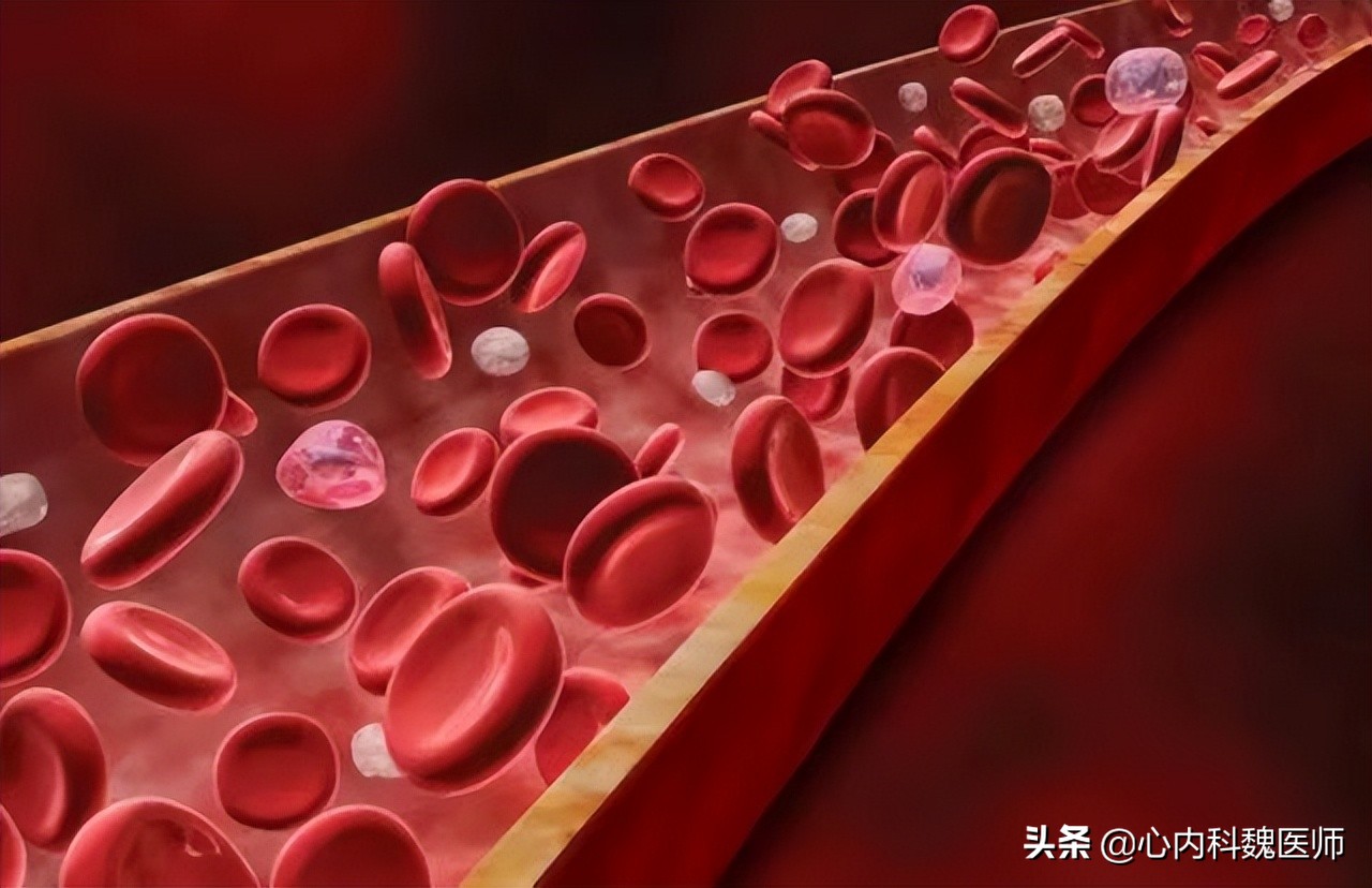 颈动脉斑块多大容易得脑梗,发现颈动脉血栓就离脑梗不远了