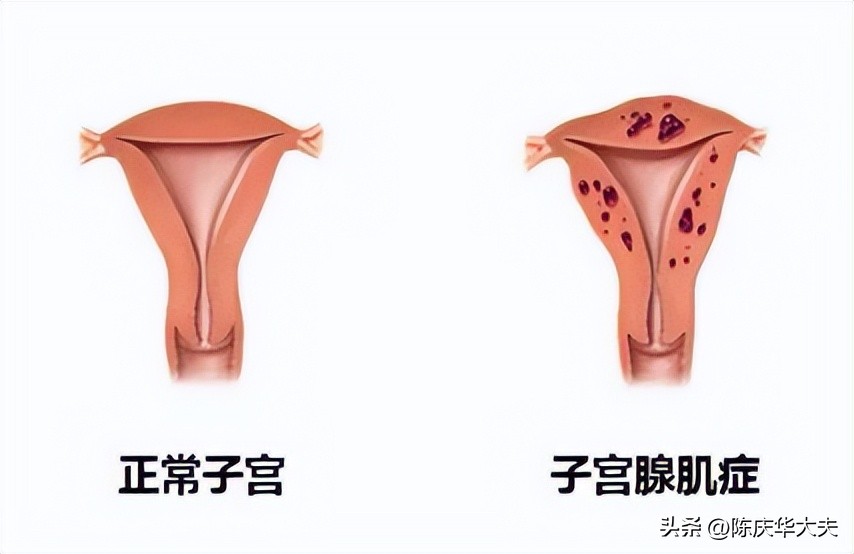 子宫肌瘤8公分可以保守治疗吗,子宫肌瘤5公分能保守治疗吗