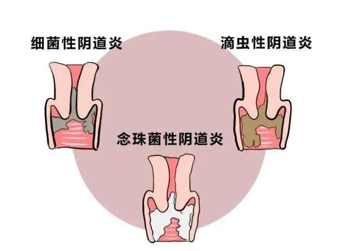 阴道炎反复发作瘙痒难忍？不过是湿热下注，中医教你从根解决