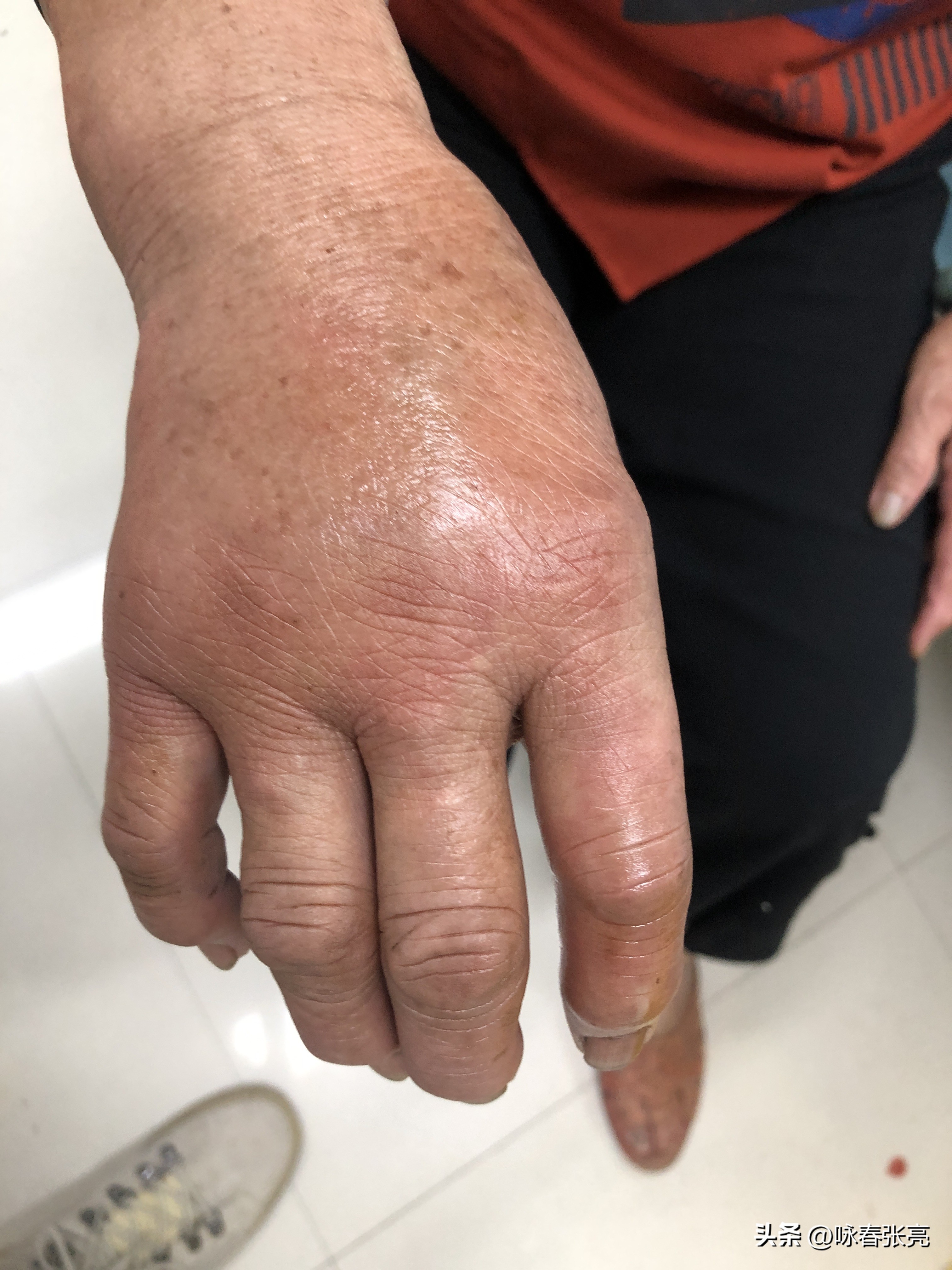 被蜈蚣咬了疼还是被蜜蜂蛰了疼,科普被蜈蚣咬了怎么处理